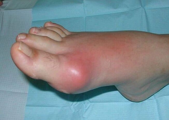 Clinical picture of foot arthritis – swelling and inflammation
