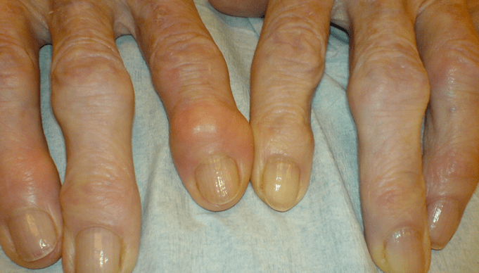 Pain in the finger joints due to osteoarthritis