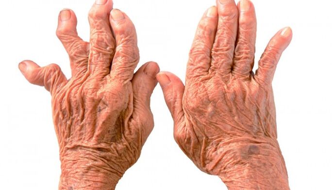 rheumatoid arthritis as a cause of pain in the finger joints