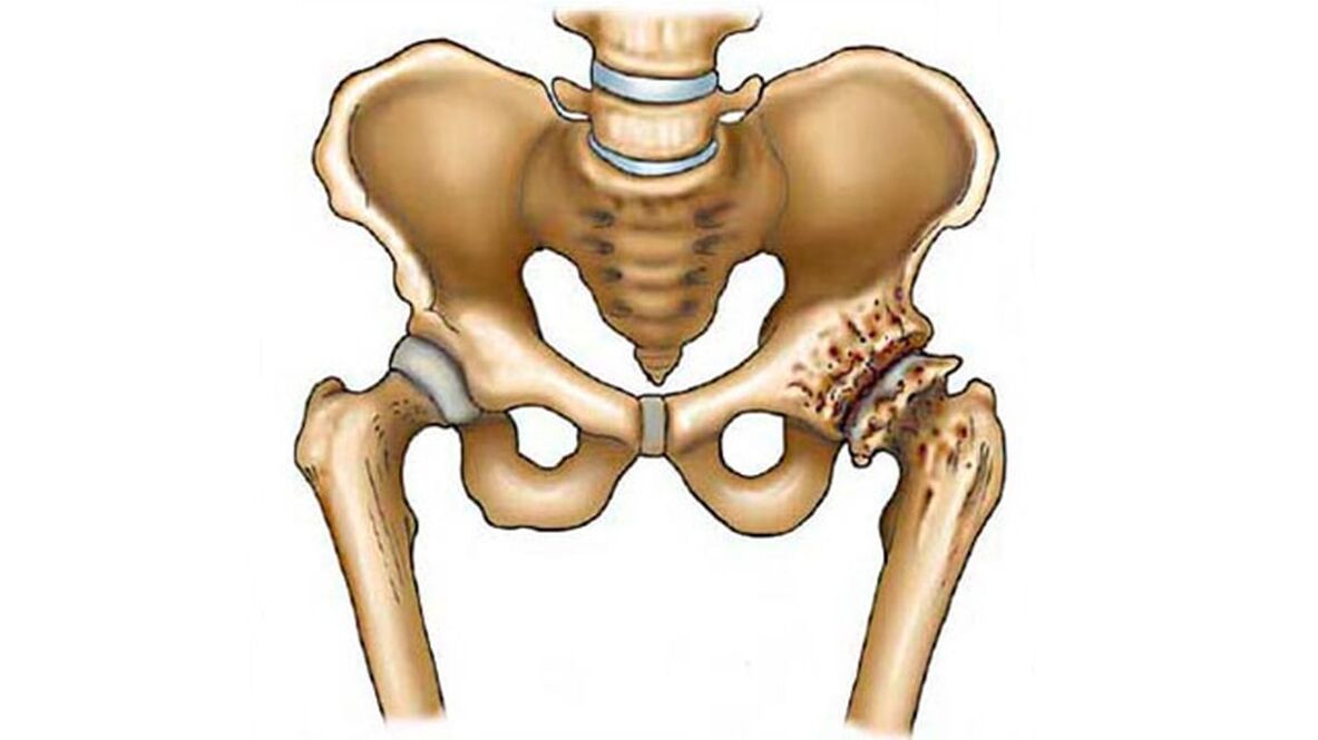 Damage to the hip joint in the presence of osteoarthritis