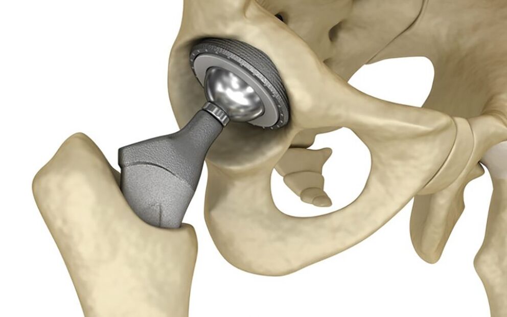 Hip replacement