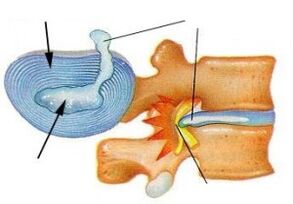 Destruction of the fibrous ring in cervical osteochondrosis