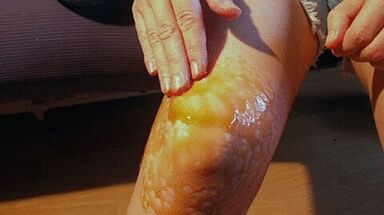 Rubbings for the treatment of osteoarthritis of the knee joint