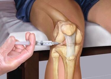 Injection in the joint