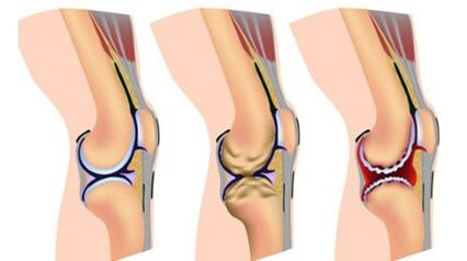 Three levels of severity of the disease