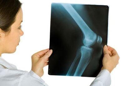 Treatment of the arthrosis of the knee joint