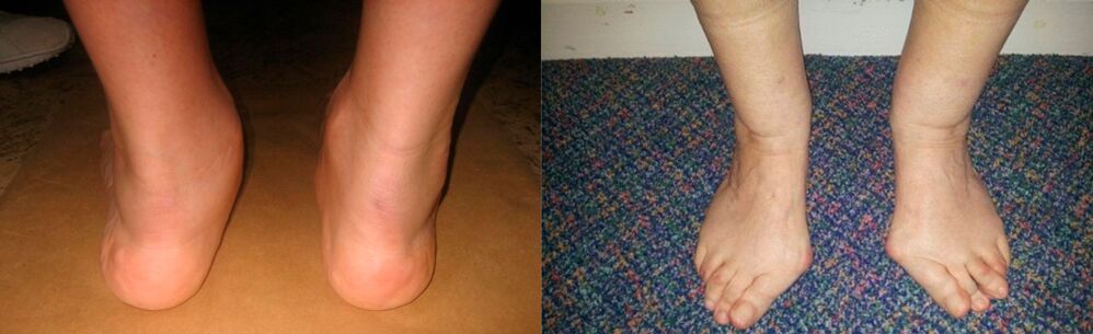 Arthrosis of the big toe and deforming arthrosis of the ankle