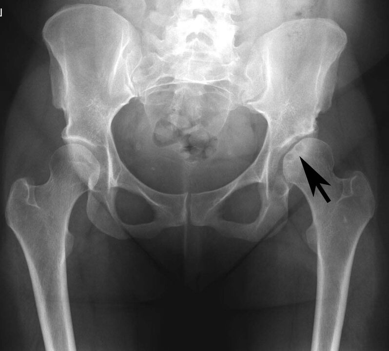Deposition of calcium salts in the hip joint with pseudogout in the radiograph