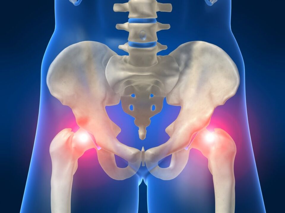 Pain on both sides of the hip joint is disturbing in Bechterew's disease
